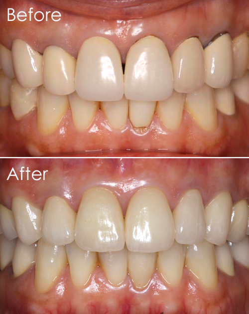 ホワイトニング before-After(ユアーズデンタルクリニック)